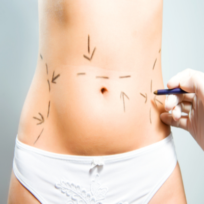 Abdominoplastia