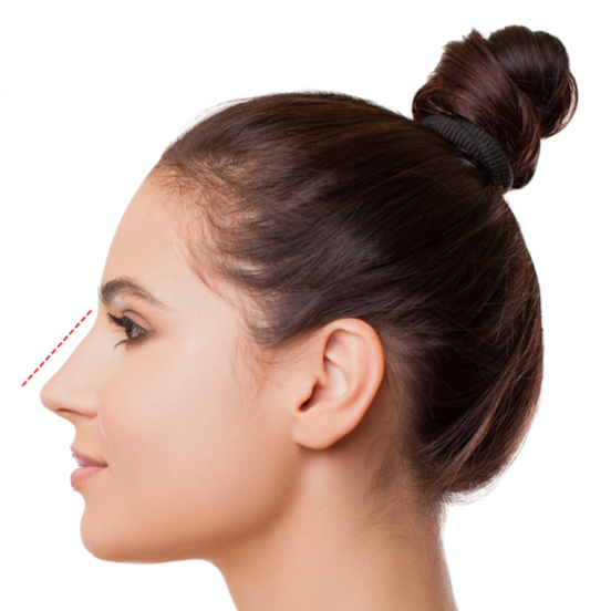 RINOPLASTIA